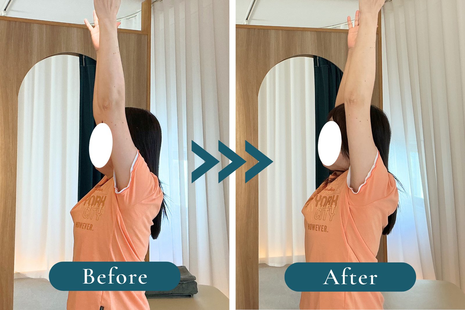 両腕を上げる動きの、施術前（Before）と施術後（After）の比較写真