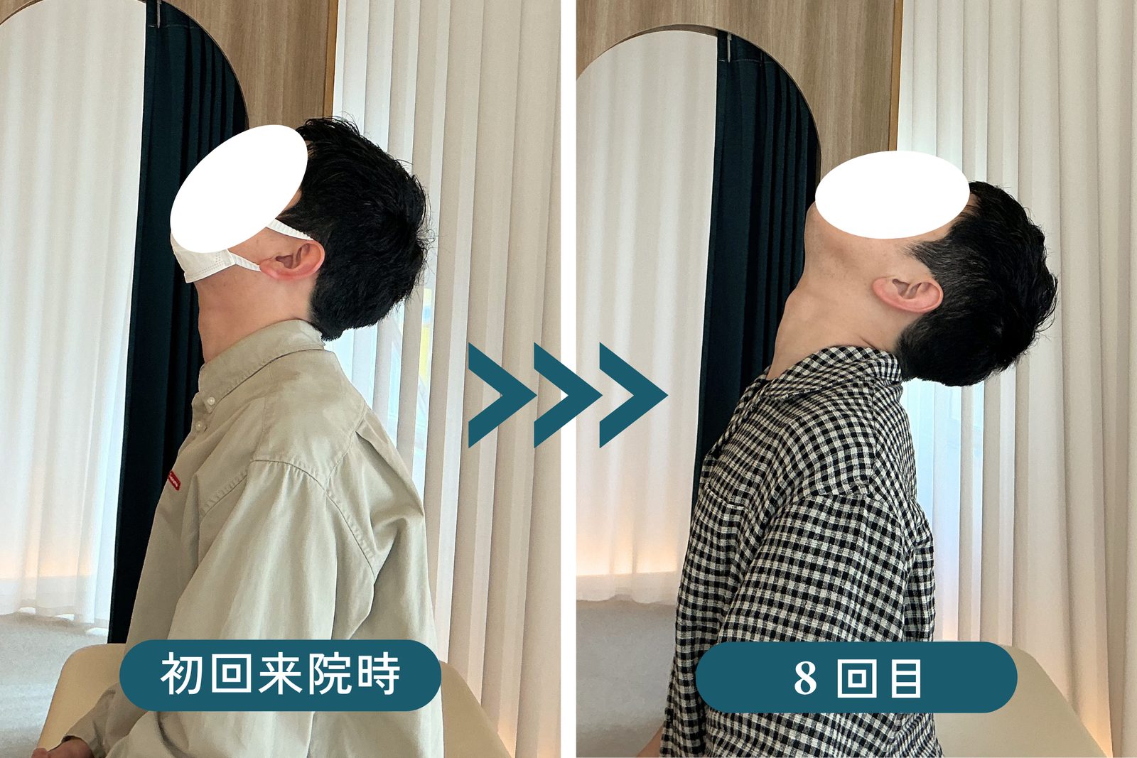 上を向く動きの、初回来院時と8回目の比較写真