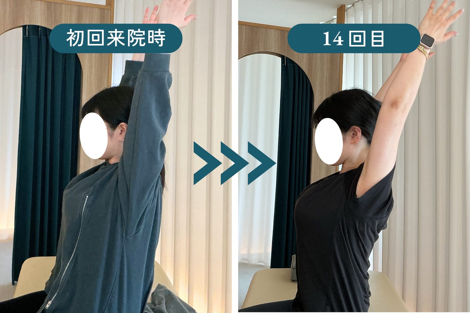 両腕を上げる動きの、初回来院時と14回目の比較写真